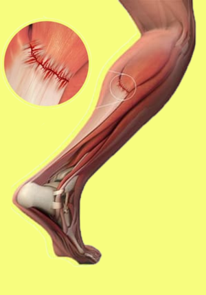 ilustración de rotura de fibras musculares
